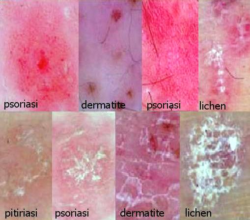 dermoscopia rosacea lichen planus